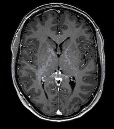 Glioblastom Glioblastom