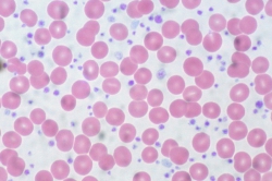 Myleoproliferative Neoplasie